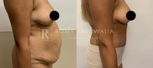 Before & After Result of Tummy Tuck Patient #39