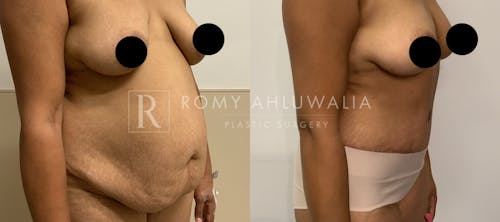 Before & After Result of Tummy Tuck Patient #39