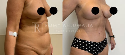 Before & After Result of Tummy Tuck Patient #40