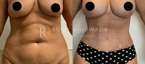 Before & After Result of Tummy Tuck Patient #40