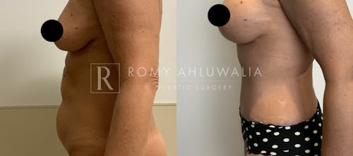 Before & After Result of Tummy Tuck Patient #40