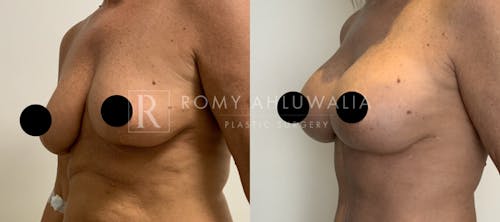 Before & After Result of Breast Augmentation With Lift Patient #1