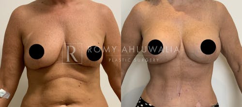Before & After Result of Breast Augmentation With Lift Patient #1