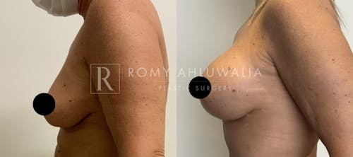 Before & After Result of Breast Augmentation With Lift Patient #1