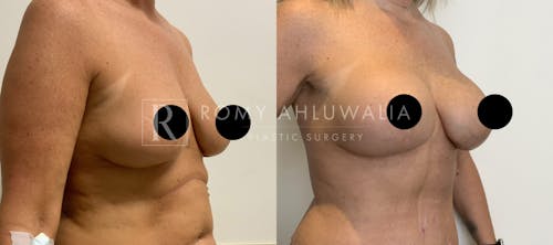 Before & After Result of Breast Augmentation With Lift Patient #1