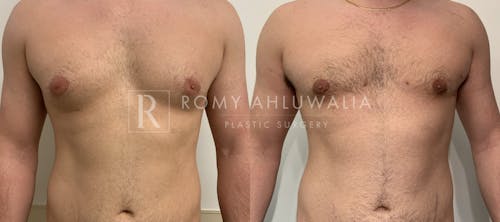 Before & After Result of Gynecomastia Patient #1