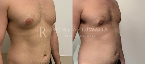 Before & After Result of Gynecomastia Patient #1