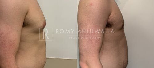 Before & After Result of Gynecomastia Patient #1