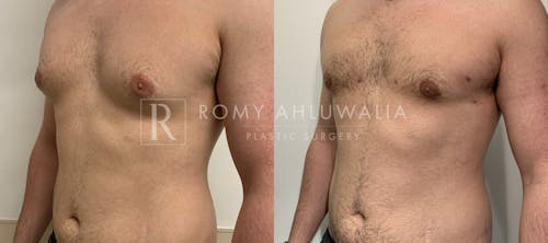 Before & After Result of Gynecomastia Patient #1