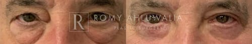 Before & After Result of Upper & Lower Eyelid Surgery Patient #8