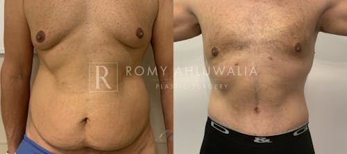 Before & After Result of Tummy Tuck Patient #41