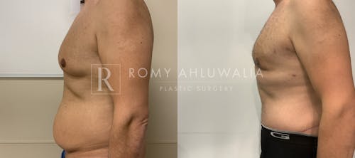 Before & After Result of Tummy Tuck Patient #41