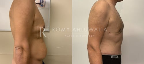 Before & After Result of Tummy Tuck Patient #41