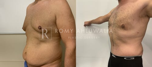 Before & After Result of Tummy Tuck Patient #41
