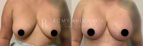 Before & After Result of Breast Augmentation Patient #19