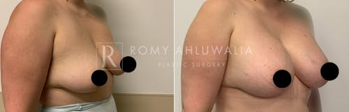 Before & After Result of Breast Augmentation Patient #19