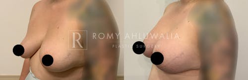 Before & After Result of Breast Augmentation Patient #19