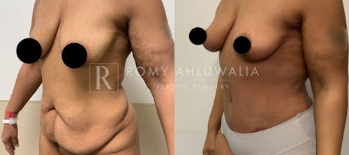 Before & After Result of Tummy Tuck Patient #42
