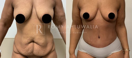 Before & After Result of Tummy Tuck Patient #42