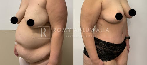 Before & After Result of Tummy Tuck Patient #43