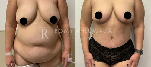 Before & After Result of Tummy Tuck Patient #43