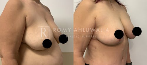 Before & After Result of Breast Reduction Patient #21