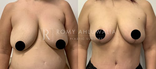 Before & After Result of Breast Reduction Patient #21