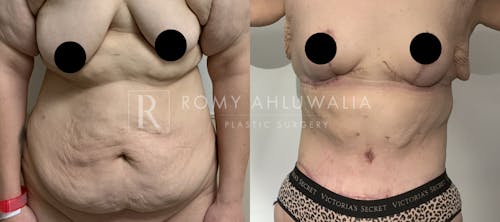 Before & After Result of Tummy Tuck Patient #44