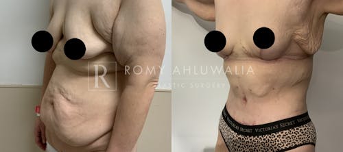 Before & After Result of Tummy Tuck Patient #44