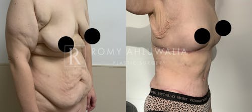 Before & After Result of Tummy Tuck Patient #44