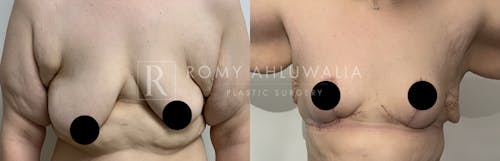 Before & After Result of Breast Asymmetry Correction Patient #1