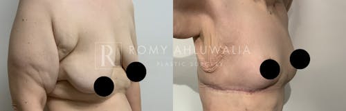 Before & After Result of Breast Asymmetry Correction Patient #1