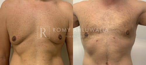 Before & After Result of Gynecomastia Patient #2