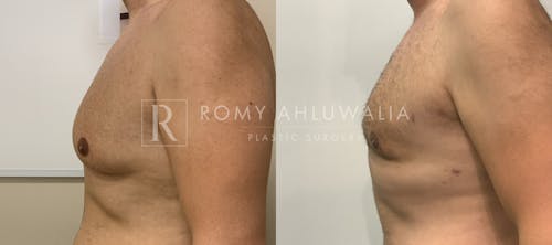 Before & After Result of Gynecomastia Patient #2
