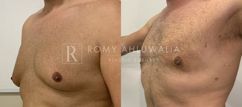 Before & After Result of Gynecomastia Patient #2