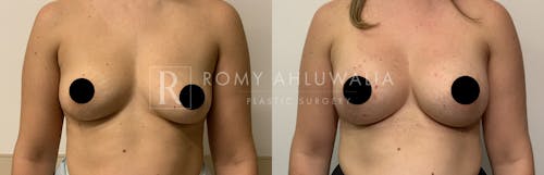 Before & After Result of Breast Augmentation Patient #20