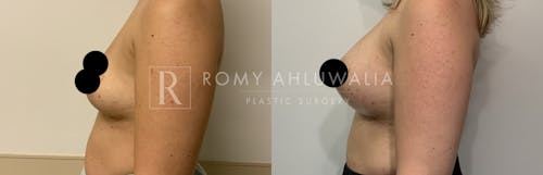 Before & After Result of Breast Augmentation Patient #20