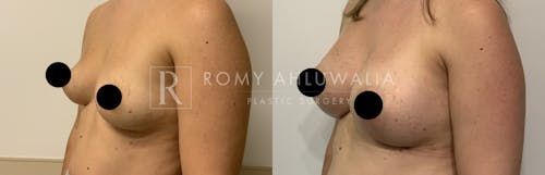 Before & After Result of Breast Augmentation Patient #20