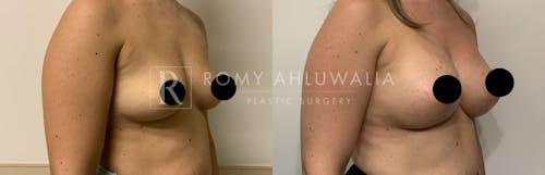Before & After Result of Breast Augmentation Patient #20