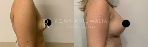 Before & After Result of Breast Augmentation Patient #20
