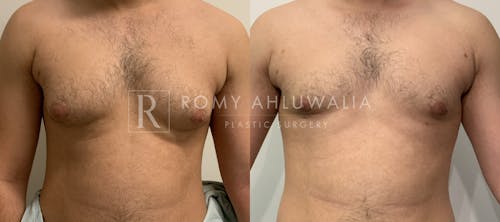 Before & After Result of Gynecomastia Patient #3