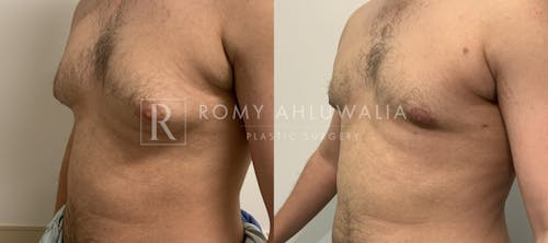 Before & After Result of Gynecomastia Patient #3