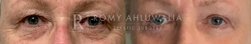 Before & After Result of Upper & Lower Eyelid Surgery Patient #9
