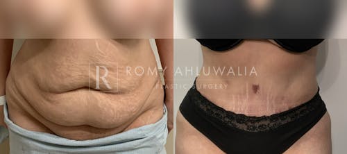 Before & After Result of Tummy Tuck Patient #45