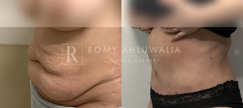 Before & After Result of Tummy Tuck Patient #45