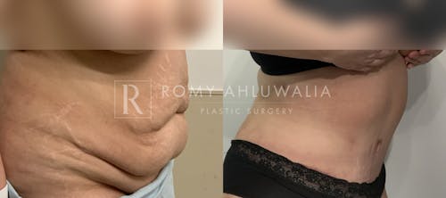 Before & After Result of Tummy Tuck Patient #45