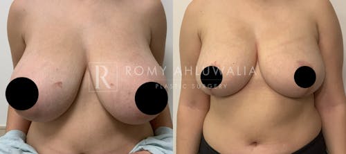Before & After Result of Breast Reduction Patient #27