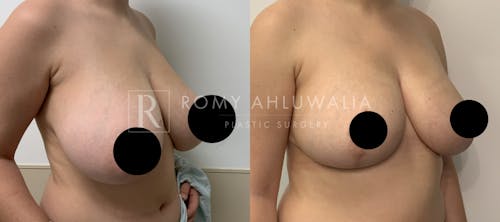 Before & After Result of Breast Reduction Patient #27