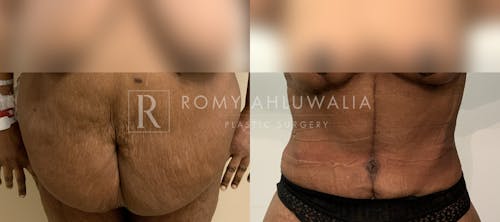 Before & After Result of Tummy Tuck Patient #46