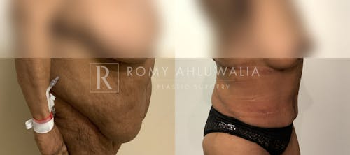 Before & After Result of Tummy Tuck Patient #46